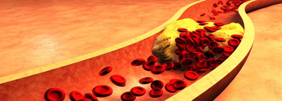 افزایش خطر ابتلا به سرطان سینه با بالا بودن کلسترول خون