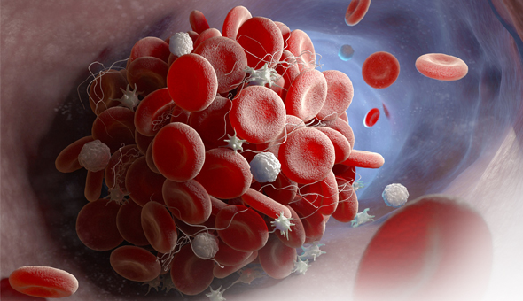 What you need to know about Deep Vein Thrombosis